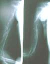 Osteomielitis de húmero y secuestro óseo de 10 cm