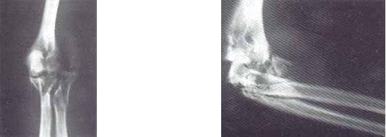 Radiografía AP y lateral de codo con fractura conminuta cúpula radial
