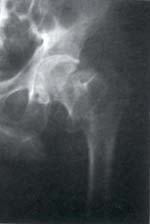 Fractura inestable intertrocánterica de la cadera izquierda