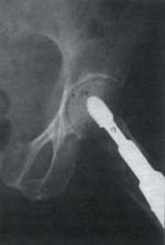 Fractura intertrocánterica cadera izquierda posición implante