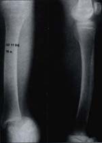 Hemimelia fibular