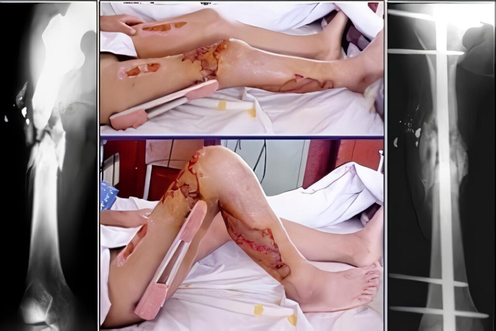 Tratamiento Quirúrgico de las Fracturas Supracondíleas de Fémur con Clavo Endomedular Supracondíelo Retrógrado