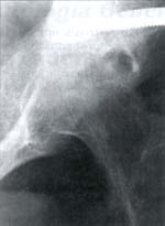 Artritis tuberculosa de cadera izquierda