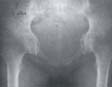 Radiografía en proyección anteroposterior de pelvis