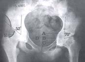 Radiografia AP pelvis bilateral