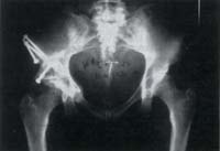 Radiografia de osteotomia de Ganz