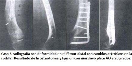 Radiografía con deformidad en el fémur distal