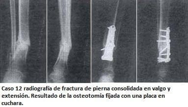 Radiografía de fractura de pierna consolidada en valgo