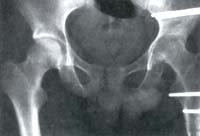 Artrosis séptica cadera izquierda