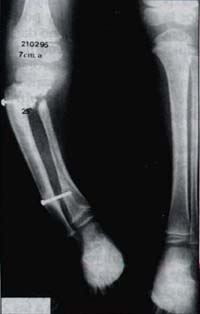 Alteración de la fisis tibial distal por material de osteosíntesis