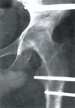 Transporte óseo fémur ipsilateralpor fractura abierta grado III