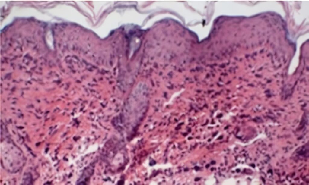 Causa genética dermatitis