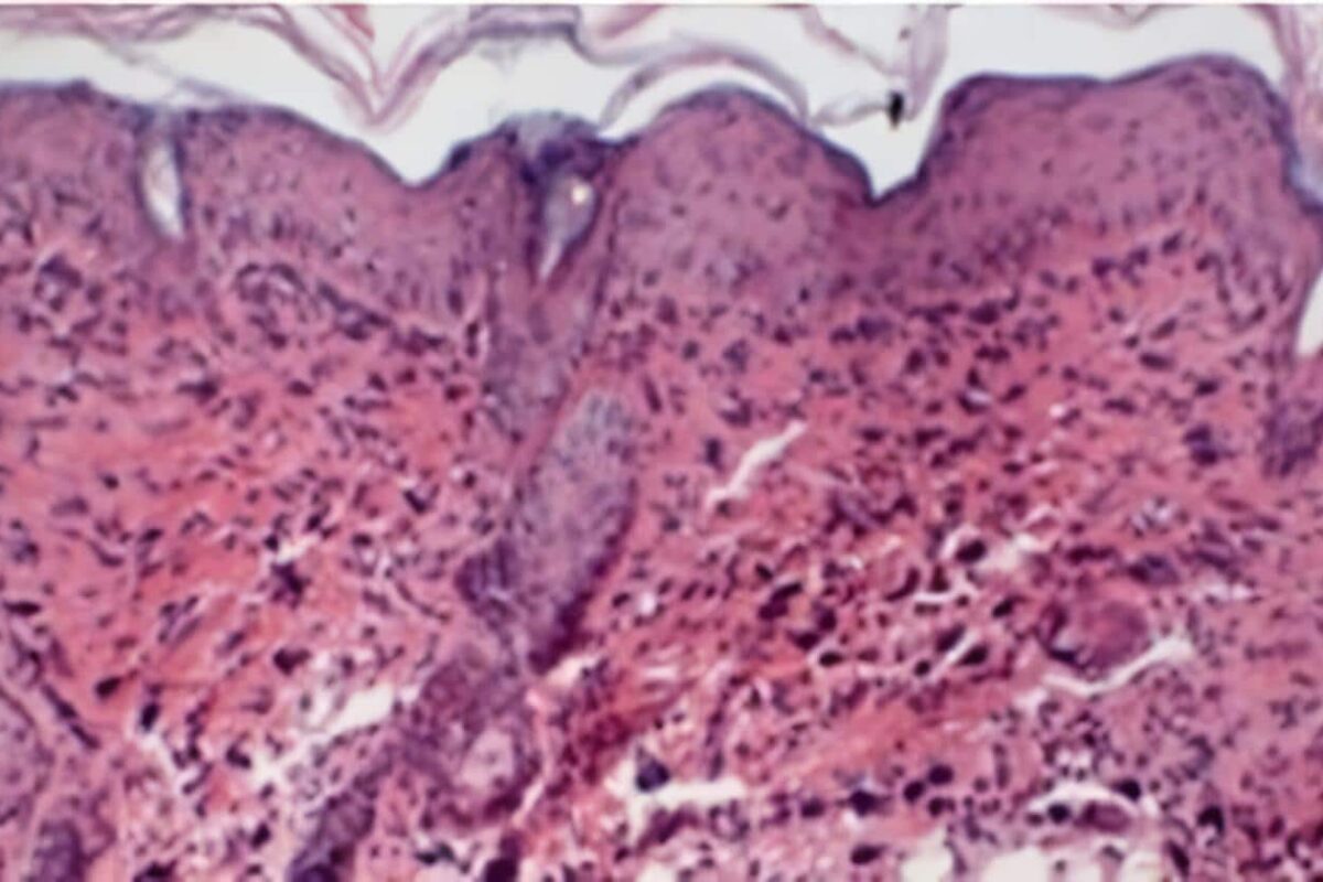 Causa genética dermatitis