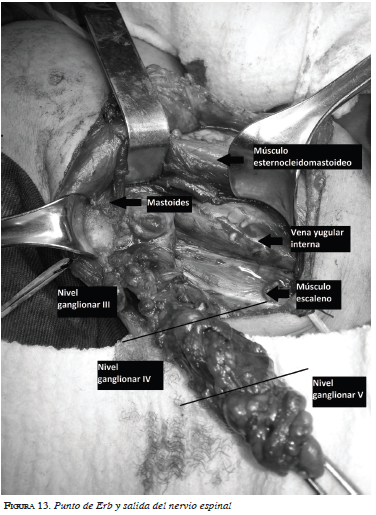 Punto de Erb y salida del nervio espinal