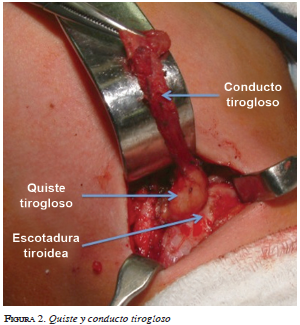 Quiste y conducto tirogloso