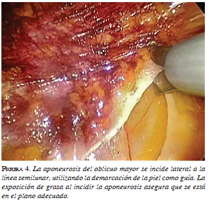 La aponeurosis del oblicuo mayor se incide lateral a la línea semilunar