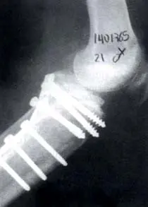 fractura del platillo tibial posteromedial