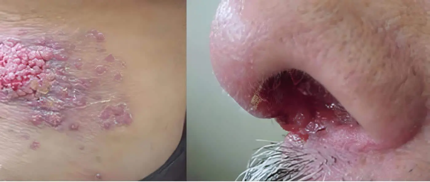 Leishmaniasis mucosa