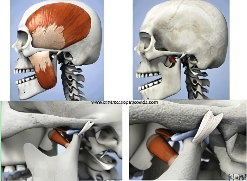 Fijación Anterior de la Columna Torácica y Lumbar