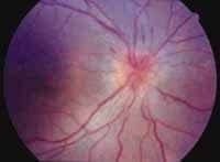 Angiofluoresceinografía ocular
