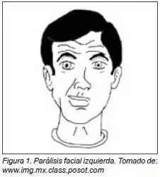 Parálisis facial izquierda