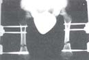 Radiografía al inicio de elongación bilateral de fémures