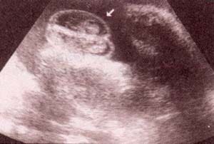 Diagnóstico Prenatal -  34 semanas.