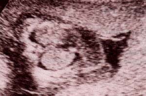 Diagnóstico Prenatal -  38 semanas. al final del tercer trimestre