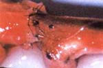 Sutura del tubo perineural con el extremo distal