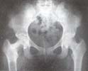 Radiografía de pelvis que muestra las lesiones