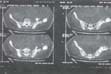 Tomografía axial computarizada de corticales del iliaco izquierdo