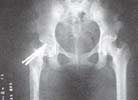 Radiografía control 8 meses posquirúrgico que muestra integración de injertos