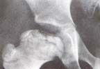 Deformidad cabeza del fémur por la parte lateral de la epífisis