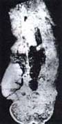 Pieza anatomopatológica del extremo inferior del fémur