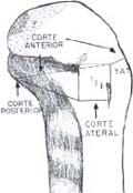 Osteotomía autobloqueante (Vista lateral) Tibia