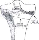 Osteotomía autobloqueante tendón patela