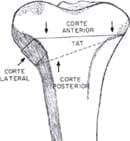 Osteotomía autobloqueante de tibia