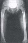 Radiografía despues de retirado fijador