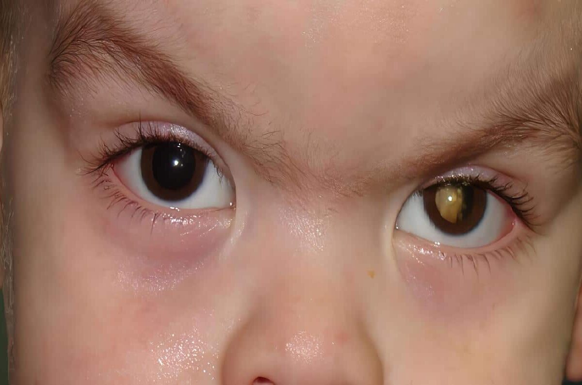 Retinoblastoma