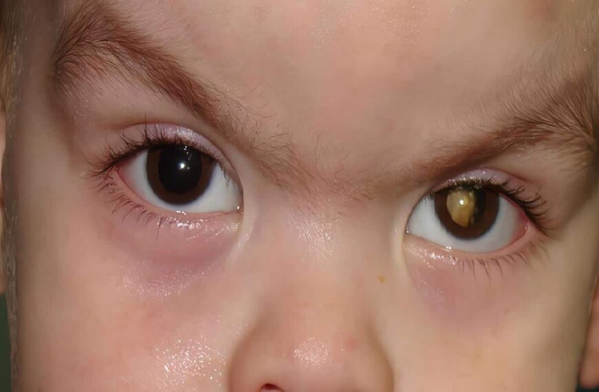 Retinoblastoma