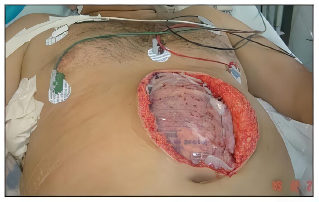 Uso de Malla en Abdomen Abierto, en Sepsis Intraabdominal, Discusión