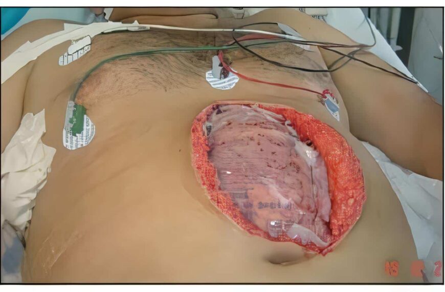 Uso de Malla en Abdomen Abierto