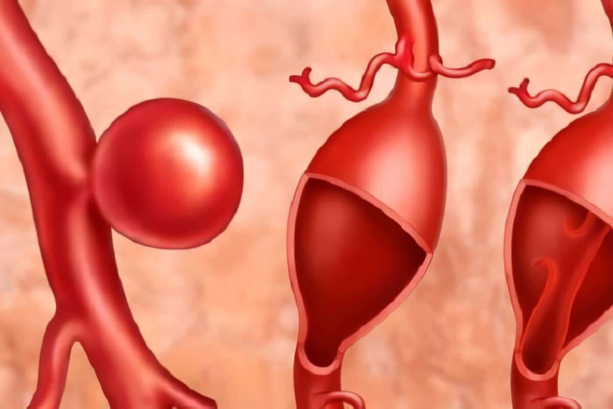 Aneurismas de Aorta Abdominal