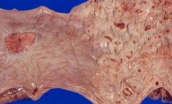 Neumatosis Intestinal