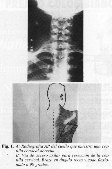 Radiografía AP del cuello que muestra una costilla cervical derecha