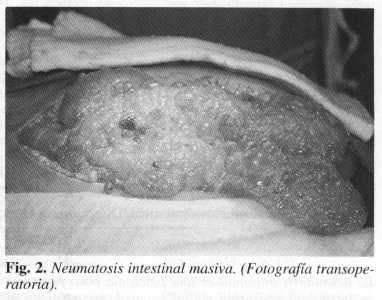 Neumatosis intestinal masiva