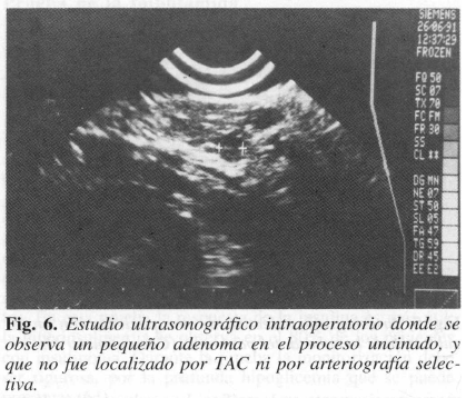 Estudio ultrasonográfico intraoperatorio se observa un pequeño adenoma 