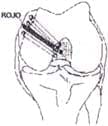 Artrotomía parapatelar interna - Ligamento cruzado posterior