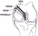 Artrotomía parapatelar interna - Ligamento cruzado posterior LCP