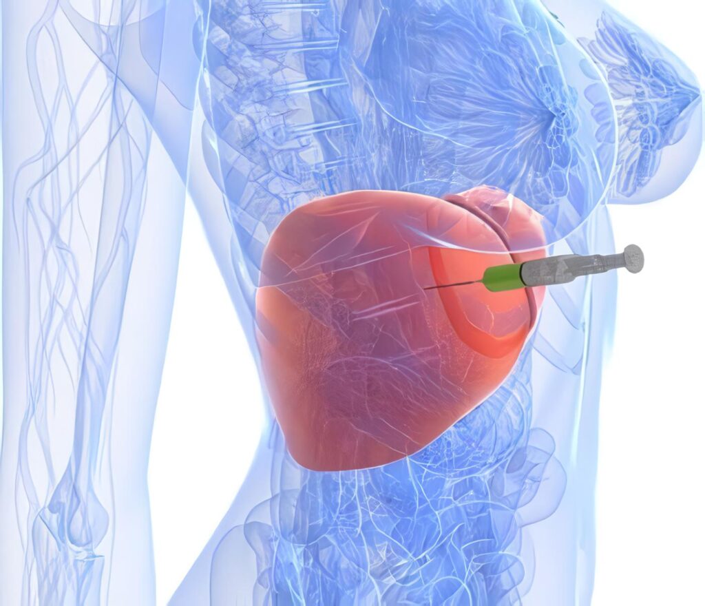 Adelantos Científicos y Técnicos* : Hemangioma Cavernoso del Hígado